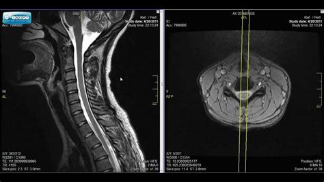 Normal Spine Mri | www.pixshark.com - Images Galleries With A Bite!