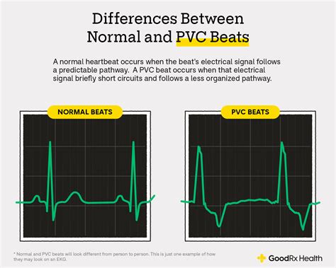 Premature Ventricular Contractions Pvcs Disease Reference Guide | Porn ...