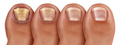 Thick Discolored Toenails: Medical Solution - Moore Foot & Ankle