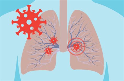 How Covid Can Damage Your Lungs – Cleveland Clinic