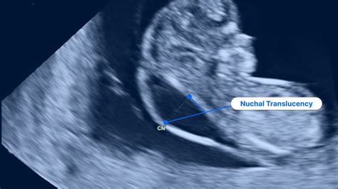 Nuchal Translucency Ultrasound (NT Scan): Test Results and More