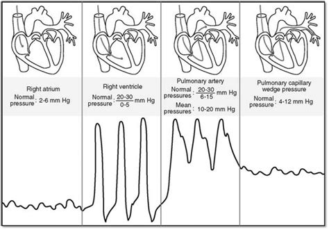 Pulmonary Artery Catheter Waveforms