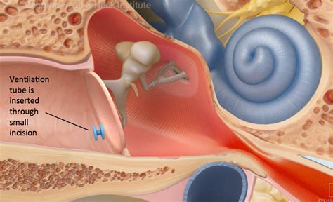 Ear Infections Treatment Los Angeles, CA