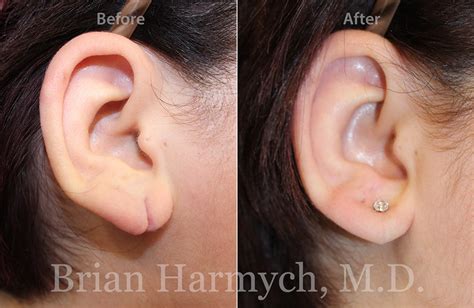 Earlobe Repair | Ear Surgery | Cleveland, OH