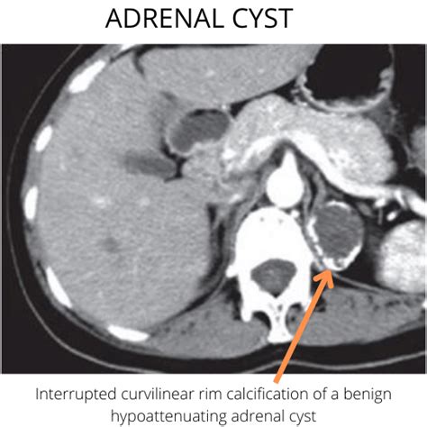 Adrenal Gland Calcification - My Endo Consult