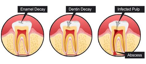 Why do I have to fix my cavity if it doesn’t hurt? - Mg Dentistry ...