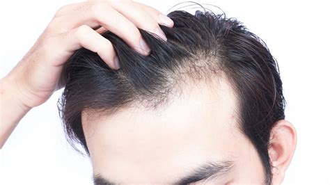 The Root of the Problem: Understanding Hair Loss Causes - 2024 Guide ...