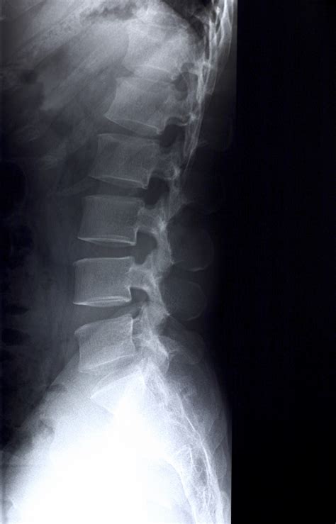 Normal Lateral Spine X Ray