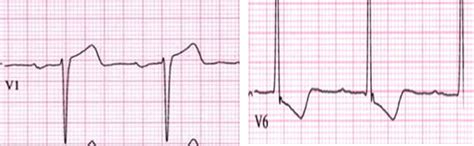 Read. Pray. Fellowship.: LVH, LAD, GCS, RSI