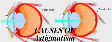 Astigmatism : Causes, Symptoms & Treatment | Eyemantra