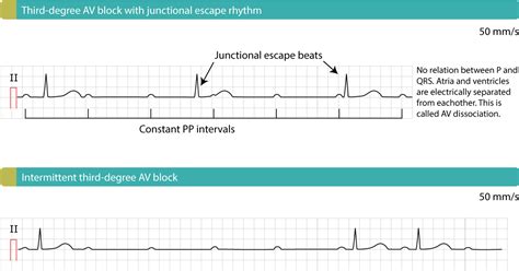 Third-degree AV block (3rd degree AV block, AV block 3, AV block III ...