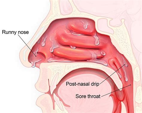 Nasal Congestion - ENT Associates