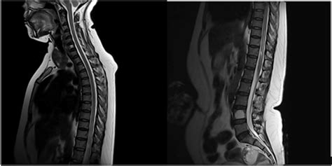 T1 fat saturated contrast MRI spine shows contrast enhancement of the ...