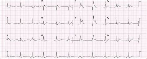 Practice 12-Lead ECG #1