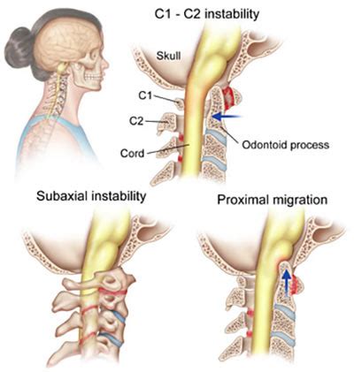 Arthritis in the Neck Treatment in NYC - Arthritis Doctor