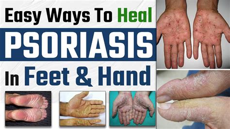 Palmoplantar Psoriasis Symptoms & Treatment | Easy Ways To Heal ...