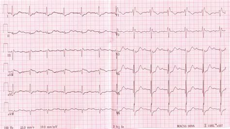 ECG Abnormalities - almostadoctor