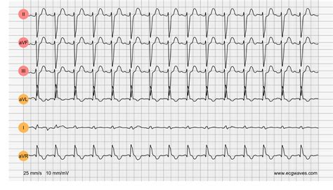 ECG Test - Quiz 4 - Mixed Conditions – Cardiovascular Education