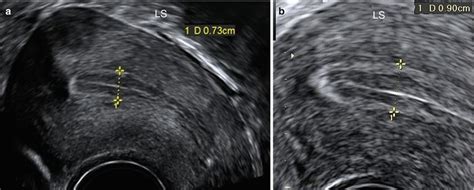 Uterine Lining Measurements