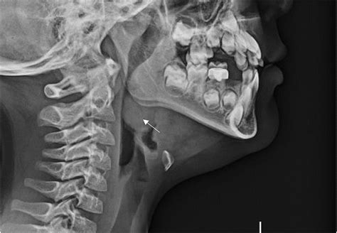 LINGUAL TONSILLITIS: AN UNDER‐RECOGNISED MANIFESTATION OF INFECTIOUS ...