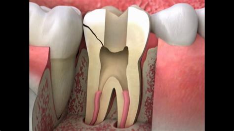 Cracked Tooth causes and Treatments - Cosmetic Dentists in Lancashire