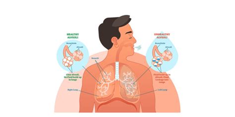 Pulmonary Vascular Congestion - An Overview