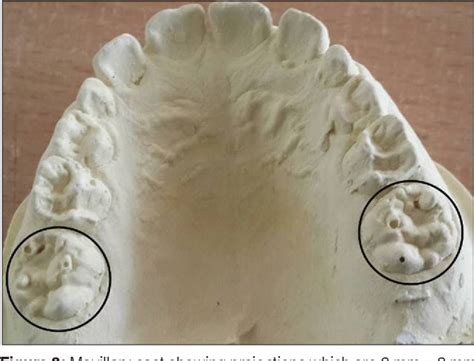 Nonsyphilitic occurrence of mulberry molars: A rare case report ...