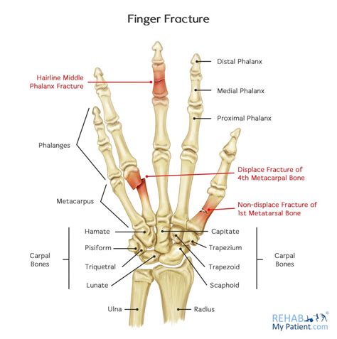 Finger Fracture | Rehab My Patient