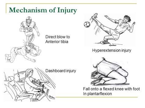 Posterior Cruciate Ligament [PCL] Tear - Sun Orthopaedic