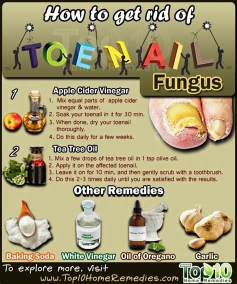 How to Get Rid of Toenail Fungus | Top 10 Home Remedies