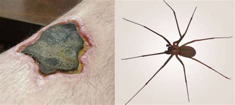 Brown Recluse Spider Bite: 7 Highlights from Experts in Arachnology ...