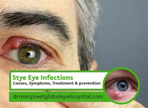 Causes, Symptoms, Treatment and prevention of Stye eye infections ...