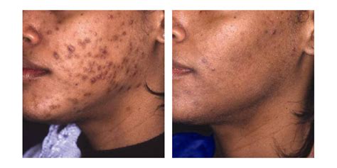 Aloe Vera For Hyperpigmentation Before And After - The before and after ...