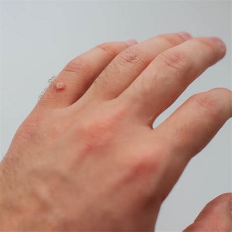 WARTS: Overview, Causes, Types, Treatment & Prevention