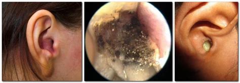 The fungus in the ear (otomycosis) - a photo, symptoms, treatment ...