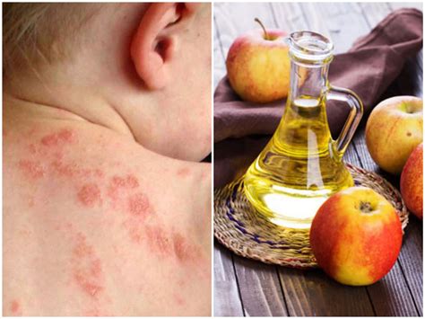 How to Treat Eczema with Apple Cider Vinegar - Best Herbal Health