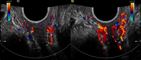 Pelvic Venous Congestion with Pelvic Heaviness and Urinary Frequency ...