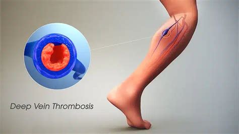 10 Alarming Signs of Deep Vein Thrombosis - Carolina Regional Orthopedics