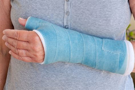 The Truth About Fiberglass Casts for Bone Fractures