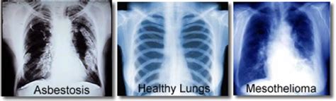 Asbestosis is a lung condition caused by inhaling high levels of ...