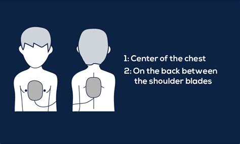 Automated External Defibrillator Pad Placement