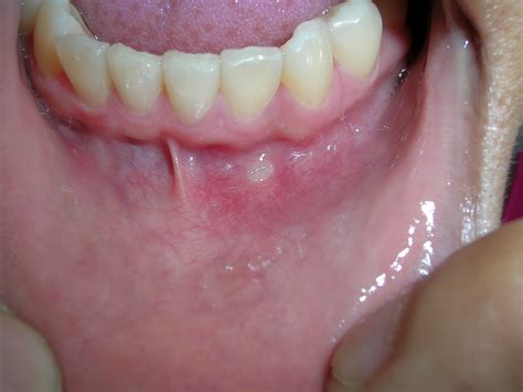 Mouth Ulcers