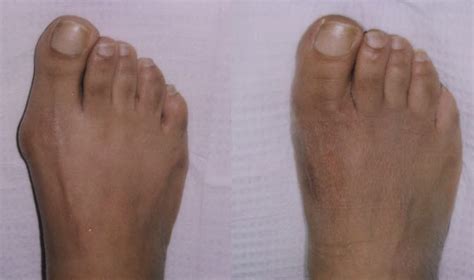 Bunion Surgery Before and After