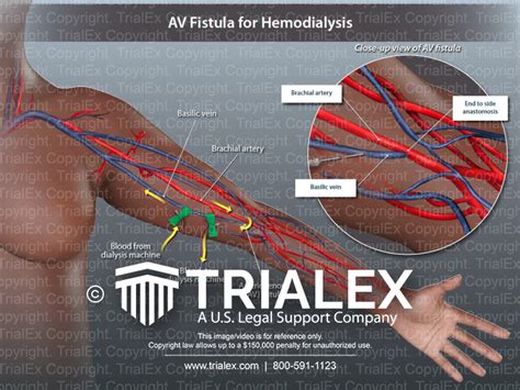 AV Fistula for Hemodialysis - TrialExhibits Inc.