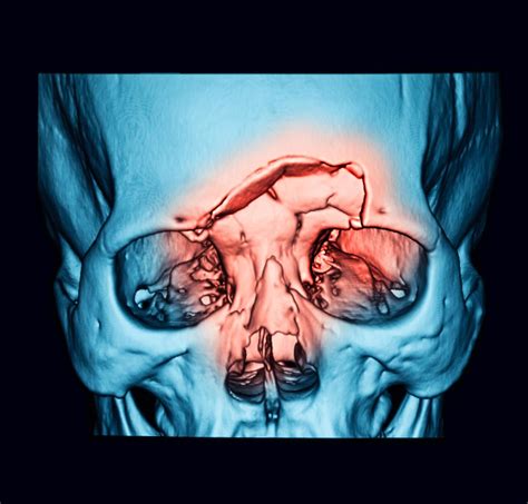 Types of Orbital Reconstructive Surgery | Annapolis and Severna Park, MD