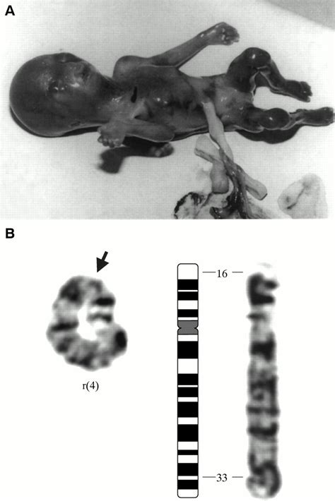 Partial deletion of 4p and 4q in a fetus with ring chromosome 4 ...