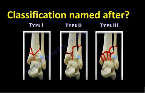 Tibial Pilon Fracture Classification — OrthopaedicPrinciples.com