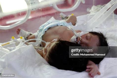 Conjoined Twins Surgery Photos and Premium High Res Pictures - Getty Images