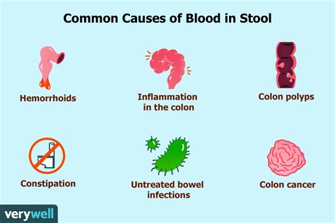 Colon Cancer Stool Color Chart