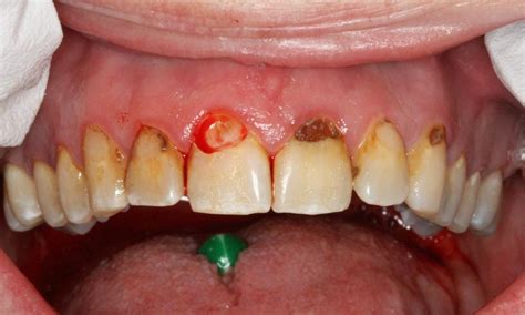 Anterior White Fillings Before & After Photos | Lead SD